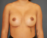 Feel Beautiful - Breast Augmentation 162 - After Photo